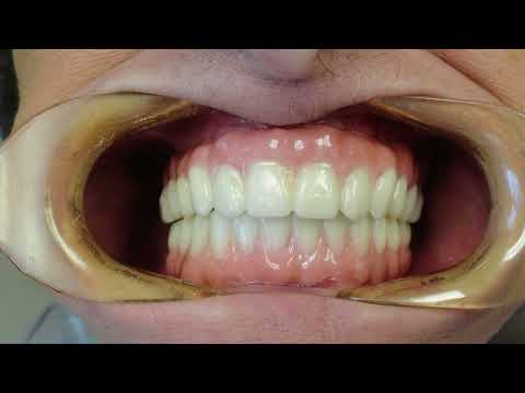 Elevator Pitch – Full Zirconia Arch – “All on 4” Implant Restoration – Utica Dental Lab [Video]